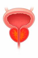 Inflammation de la prostate.