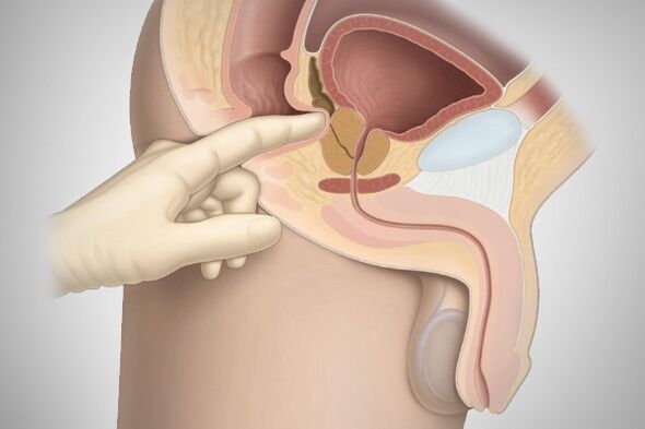 Massage de la prostate pour la prostatite bactérienne.